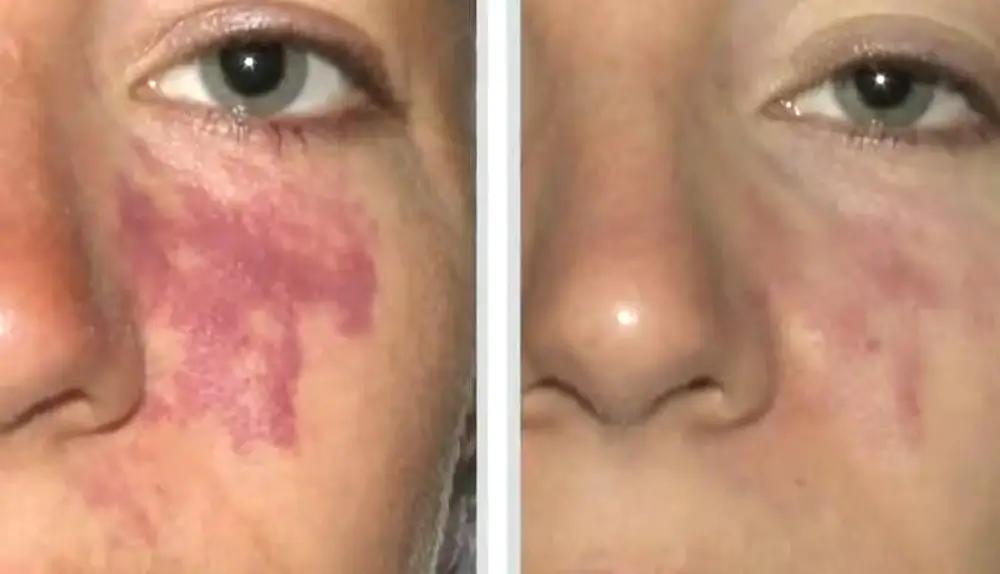 IPL-Photorejuvenation-03